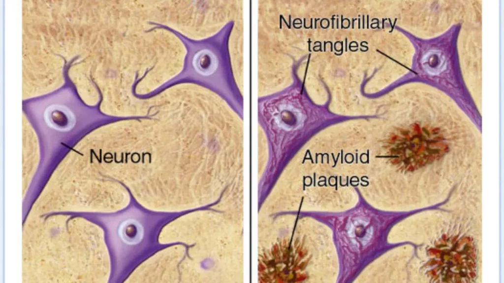 Alzheimers Neuron diagrams
