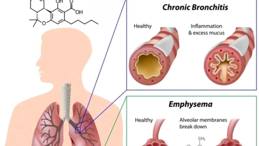 Chronic Bronchitis diagram